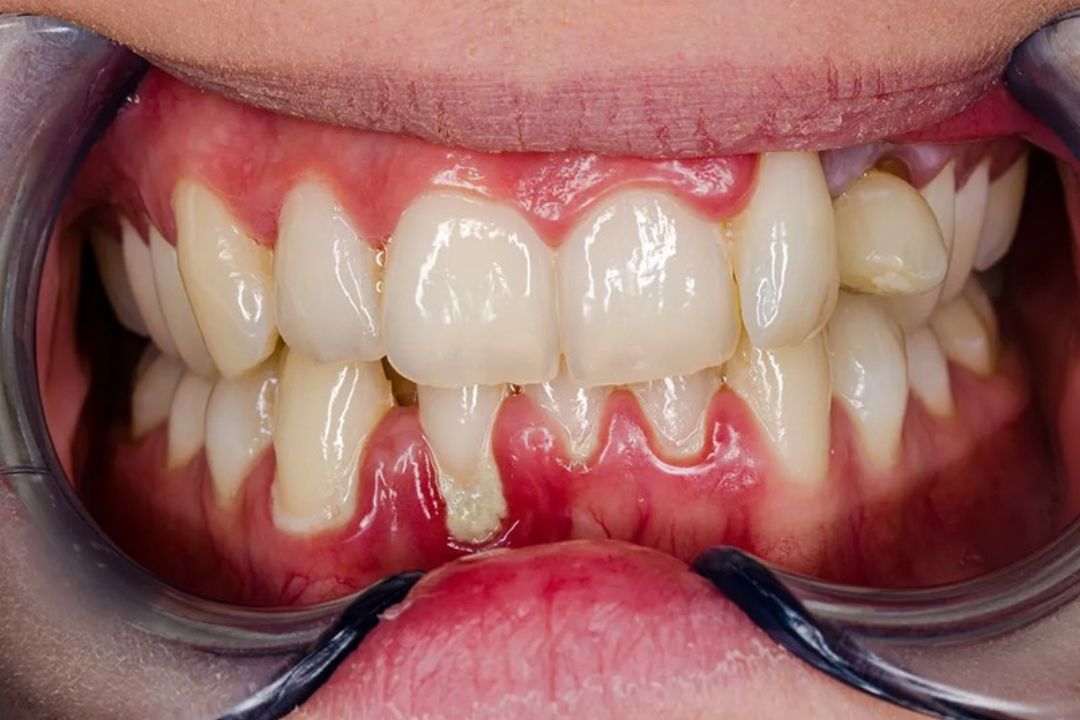 Bleeding Gums