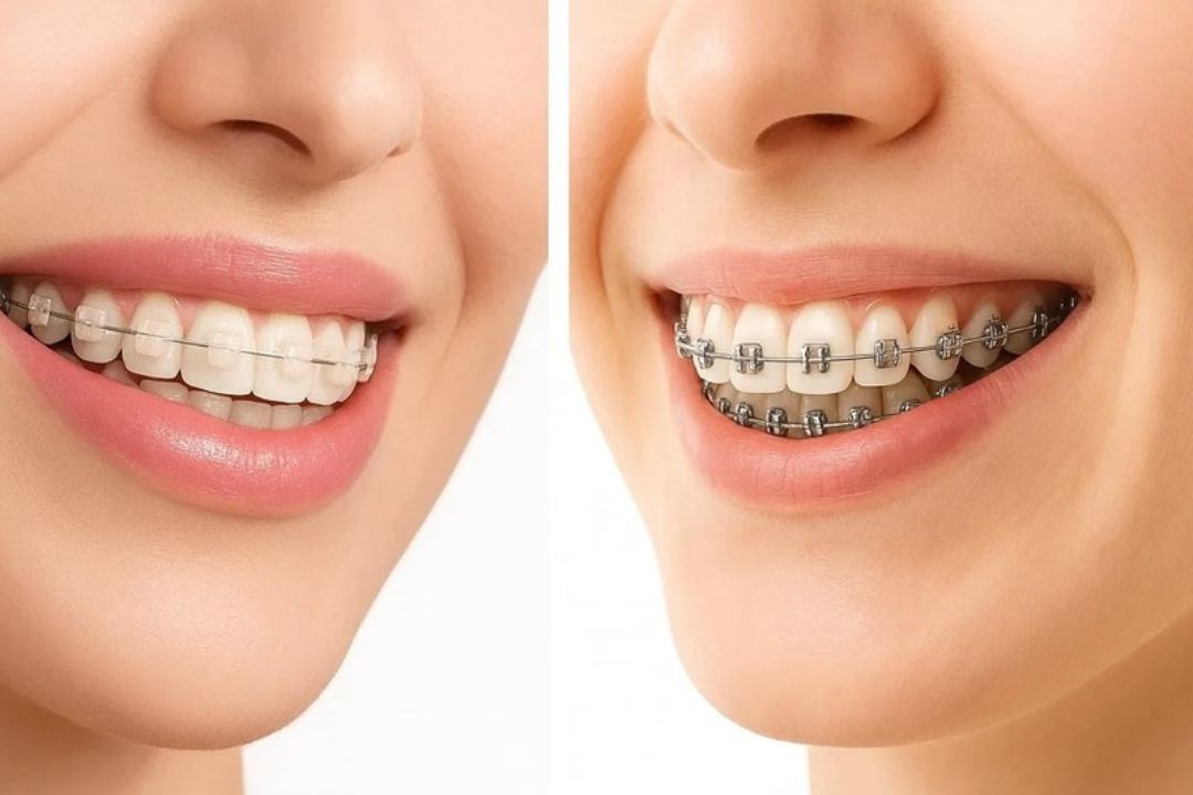 Traditional Braces