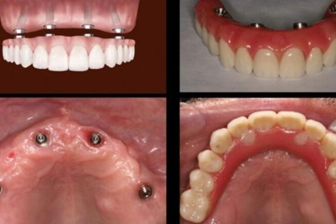 Fixed Dentures