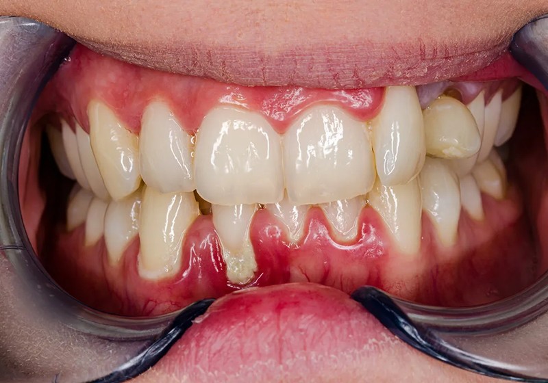 Bleeding Gums