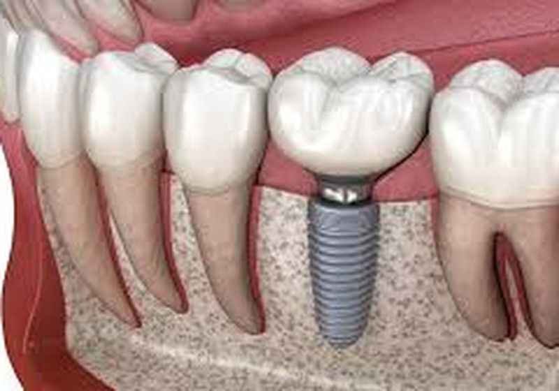 Dental Implants