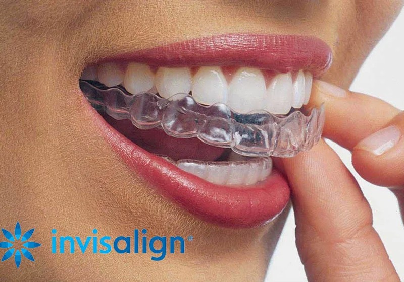 Invisible Aligners