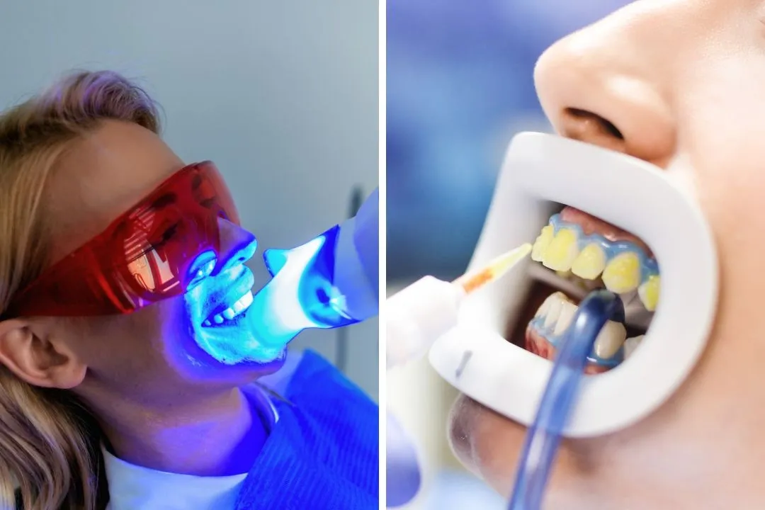 Teeth Whitening