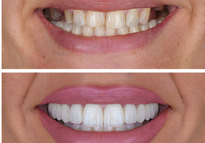Smile Makeovers